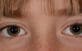 Există o serie întreagă de afecțiuni ale ochilor la copii care pot ridica probleme ale vederii. Important este să fie depistate cât mai repede și tratate corect.