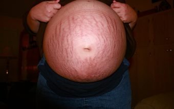 Vergeturile în timpul sarcinii nu sunt niște fenomene stranii.