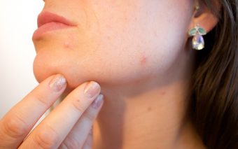 Mituri despre acnee la adulți. Acneea între mit și realitate