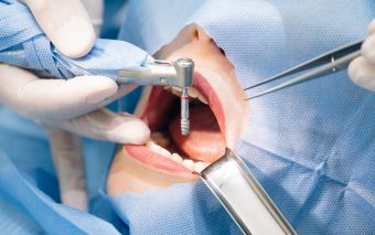 Știai că înaintea montării aparatului dentar ai nevoie de un mini implant ortodontic?