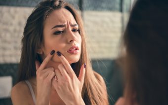 Tenul acneic: 8 greșeli pe care să nu le faci
