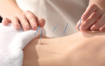 Beneficiile acupuncturii în combaterea infertilității